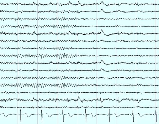 eeg monitoring